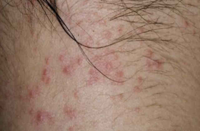 Eczema en mi cuerpo ¿Qué debo hacer si tengo en mi cuerpo? 